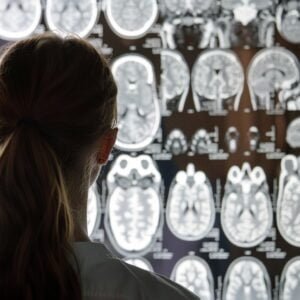 Arts met hersenscans op de achtergrond die epilepsie laten zien
